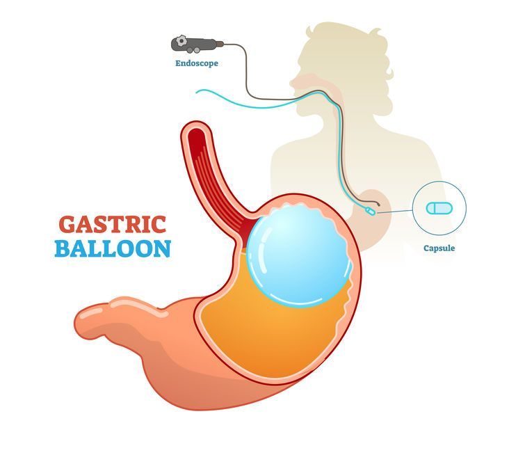 How-Does-the Gastric-Balloon System-Work Gastric-Balloon