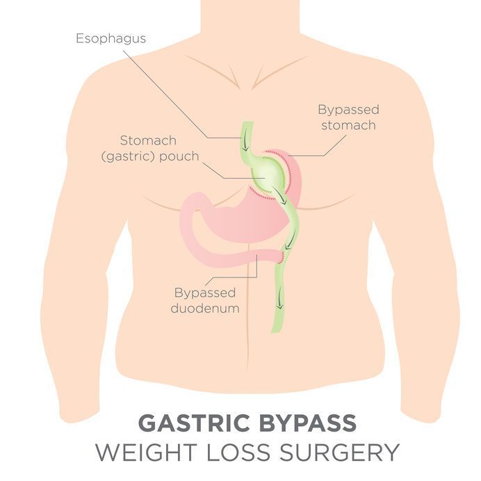 5-things-to-know-about-roux-en-y-gastric-bypass 5-things-to-know-about-roux-en-y-gastric-bypass
