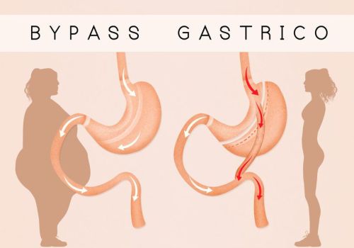 gastric bypass to reduce stomach gastric bypass to reduce stomach