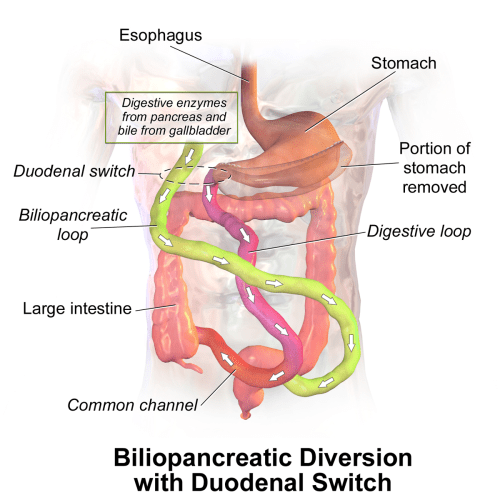 Biliopancreatic_Diversion Biliopancreatic_Diversion