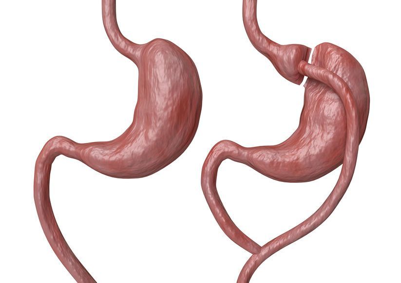 Gastric bypass is a type of bariatric surgery that consists of reducing the stomach and altering the bowel, leading to a marked loss of body weight Gastric bypass is a type of bariatric surgery that consists of reducing the stomach and altering the bowel, leading to a marked loss of body weight