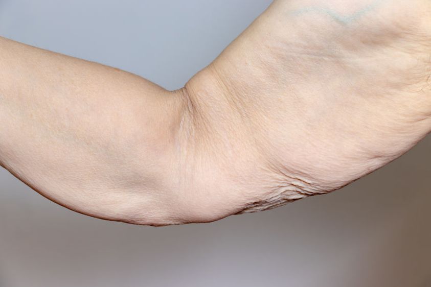 How_to_Prevent_Loose_Skin_after_Weight_Loss_Surgery How_to_Prevent_Loose_Skin_after_Weight_Loss_Surgery