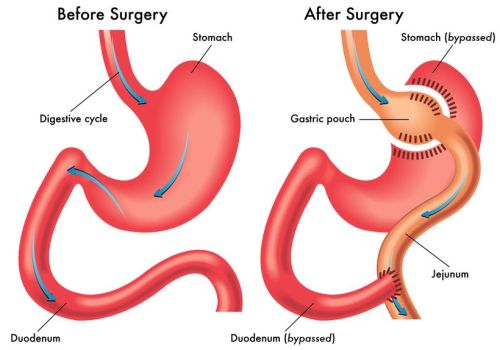 Is_Gastric_Bypass_Good_For_You Gastric Bypass