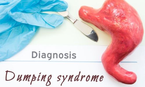 What_is_Dumping_Syndrome Dumping_Syndrome