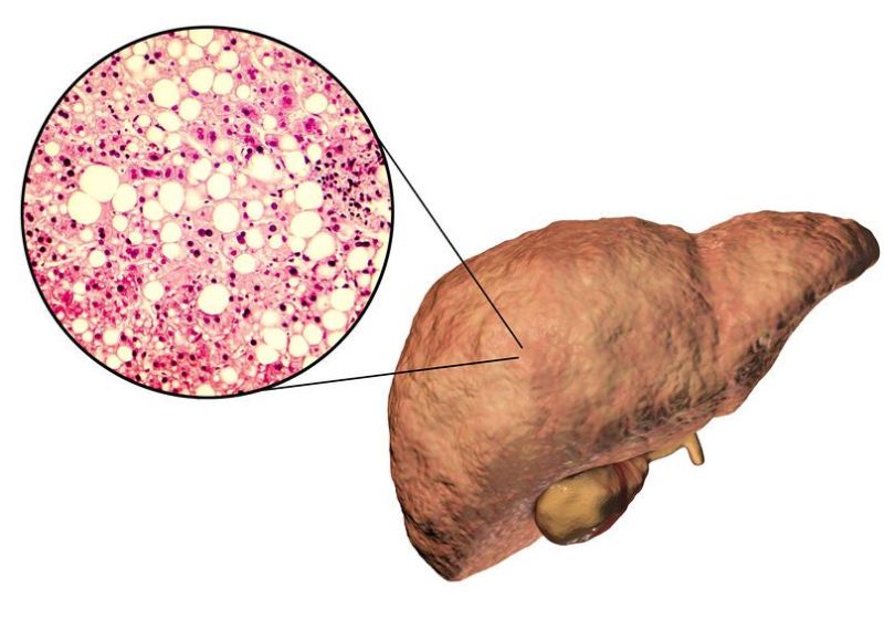 Fatty liver, liver steatosis Fatty liver, liver steatosis