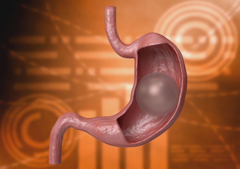 Balloon gastric. inflatable device that is placed in the stomach to reduce weight Balloon gastric. inflatable device that is placed in the stomach to reduce weight