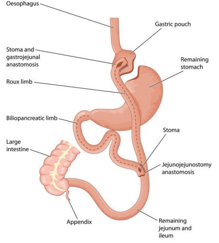 is-roux-en-y-gastric-bypass-safe is-roux-en-y-gastric-bypass-safe