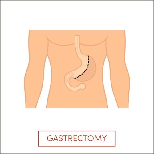 sleeve-gastronomy-is-safe sleeve-gastronomy-is-safe