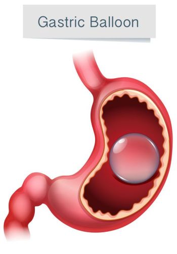 Human Anatomy Gastric Balloon Illustration Human Anatomy Gastric Balloon Illustration