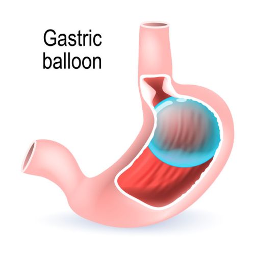 Gastric balloon. inflatable medical device for reduce weight. Gastric balloon. inflatable medical device for reduce weight.