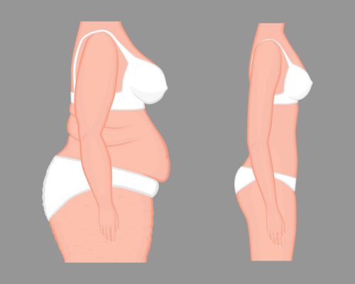 what-is-the-best-surgery-to-lose-weight what-is-the-best-surgery-to-lose-weight