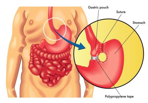 what-is-the-youngest-age-for-bariatric-surgery what-is-the-youngest-age-for-bariatric-surgery