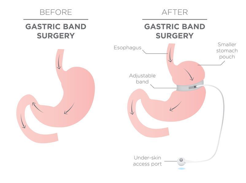 which-weight-loss-surgeries-are-reversible weight-loss-surgeries-are-reversible