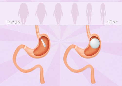 intragastric balloon surgery intragastric balloon surgery