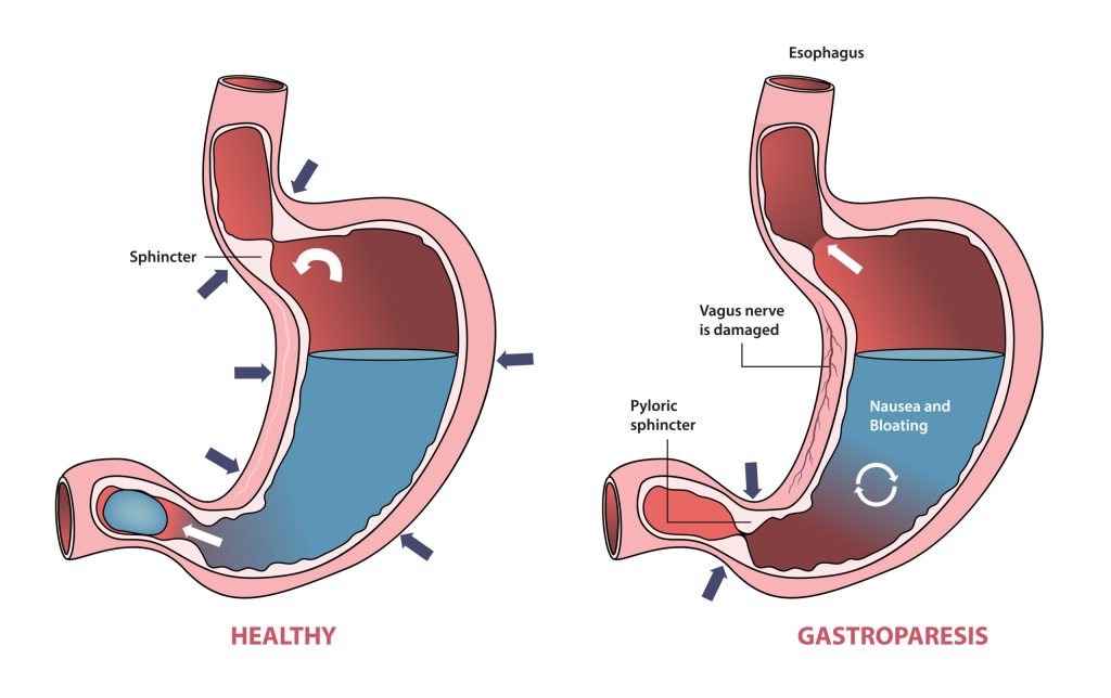 Illustration of Gastroparesis, a condition where the stomach is unable to empty food normally